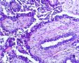 一例特殊的乳腺癌--会诊意见为：乳腺浸润性导管癌2级，考虑可能为纤维腺瘤恶变。图6