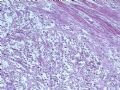 膀胱肿瘤--膀胱肉瘤样癌图1