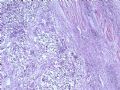 膀胱肿瘤--膀胱肉瘤样癌图2