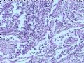 膀胱肿瘤--膀胱肉瘤样癌图5