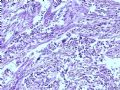 膀胱肿瘤--膀胱肉瘤样癌图6