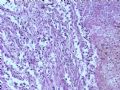 膀胱肿瘤--膀胱肉瘤样癌图7