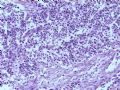 膀胱肿瘤--膀胱肉瘤样癌图8
