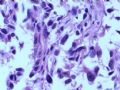 膀胱肿瘤--膀胱肉瘤样癌图11
