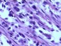 膀胱肿瘤--膀胱肉瘤样癌图12