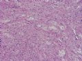 NP (4) - WHO grade IV glioblastoma, granular cell variant图2