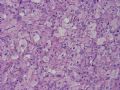 NP (4) - WHO grade IV glioblastoma, granular cell variant图3