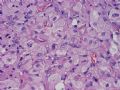 NP (4) - WHO grade IV glioblastoma, granular cell variant图4