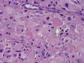 NP (4) - WHO grade IV glioblastoma, granular cell variant图5