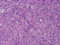 NP (4) - WHO grade IV glioblastoma, granular cell variant图7