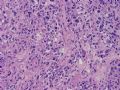 NP (4) - WHO grade IV glioblastoma, granular cell variant图8