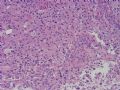 NP (4) - WHO grade IV glioblastoma, granular cell variant图11