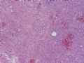 NP (4) - WHO grade IV glioblastoma, granular cell variant图13