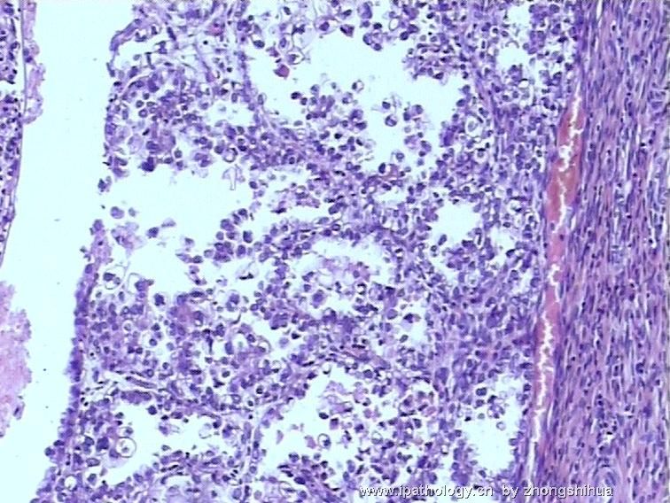 欣赏--宫颈肿瘤－宫颈透明细胞癌图3