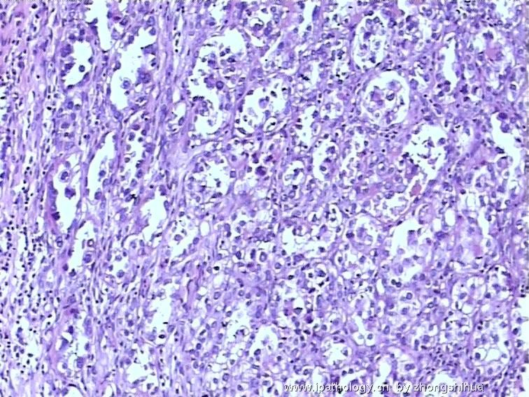 欣赏--宫颈肿瘤－宫颈透明细胞癌图4