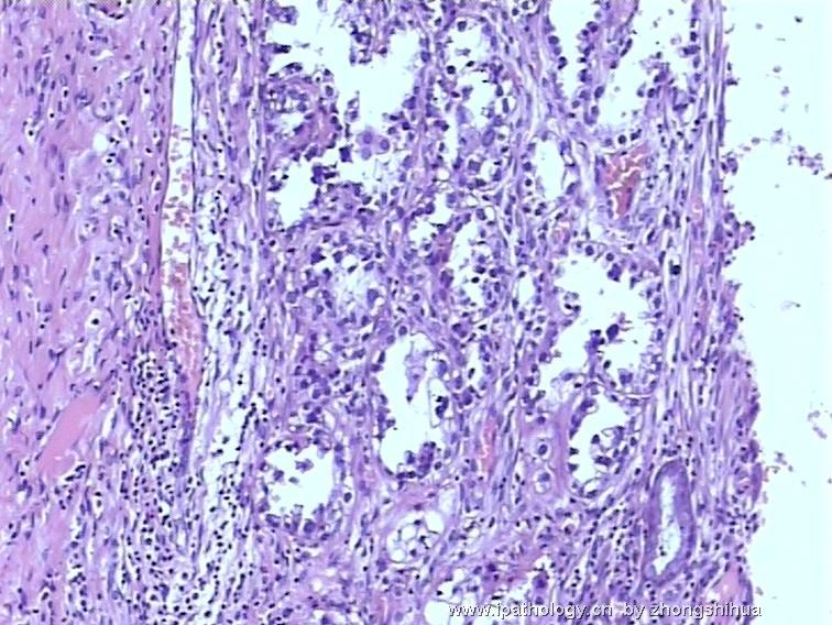 欣赏--宫颈肿瘤－宫颈透明细胞癌图5