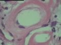 右侧腹股沟肿块-多形性透明血管扩张性肿瘤( PHAT)图10