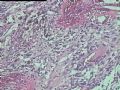右侧腹股沟肿块-多形性透明血管扩张性肿瘤( PHAT)图12