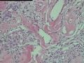 右侧腹股沟肿块-多形性透明血管扩张性肿瘤( PHAT)图18