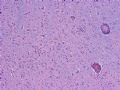 NP (6) - Paraneoplastic encephalitis and sensory polyneuropathy associated with small cell carcin..图2