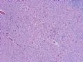 NP (6) - Paraneoplastic encephalitis and sensory polyneuropathy associated with small cell carcin..图5