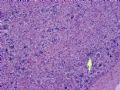 NP (6) - Paraneoplastic encephalitis and sensory polyneuropathy associated with small cell carcin..图15