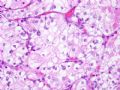 肾脏肿瘤--肾透明细胞癌伴转移性乳腺浸润性导管癌图1