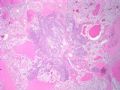 肾脏肿瘤--肾透明细胞癌伴转移性乳腺浸润性导管癌图2