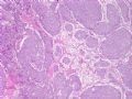 肾脏肿瘤--肾透明细胞癌伴转移性乳腺浸润性导管癌图3