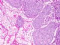 肾脏肿瘤--肾透明细胞癌伴转移性乳腺浸润性导管癌图4