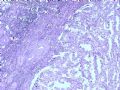 肾肿瘤－－肾乳头状肾细胞癌（2型）伴有肉瘤样分化图1