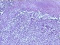 肾肿瘤－－肾乳头状肾细胞癌（2型）伴有肉瘤样分化图2