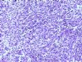 肾肿瘤－－肾乳头状肾细胞癌（2型）伴有肉瘤样分化图3