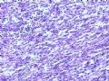 肾肿瘤－－肾乳头状肾细胞癌（2型）伴有肉瘤样分化图4