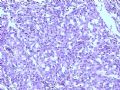 肾肿瘤－－肾乳头状肾细胞癌（2型）伴有肉瘤样分化图5