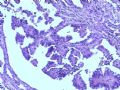 肾肿瘤－－肾乳头状肾细胞癌（2型）伴有肉瘤样分化图6