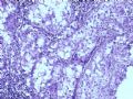 肾肿瘤－－肾乳头状肾细胞癌（2型）伴有肉瘤样分化图7
