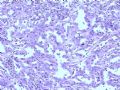 肾肿瘤－－肾乳头状肾细胞癌（2型）伴有肉瘤样分化图8
