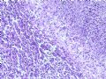 肾肿瘤－－肾乳头状肾细胞癌（2型）伴有肉瘤样分化图9