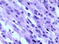肾肿瘤－－肾乳头状肾细胞癌（2型）伴有肉瘤样分化图10