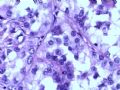肾肿瘤－－肾乳头状肾细胞癌（2型）伴有肉瘤样分化图11