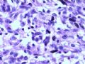 肾肿瘤－－肾乳头状肾细胞癌（2型）伴有肉瘤样分化图12