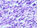 肾肿瘤－－肾乳头状肾细胞癌（2型）伴有肉瘤样分化图13