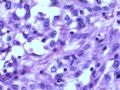 肾肿瘤－－肾乳头状肾细胞癌（2型）伴有肉瘤样分化图14