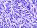 [已确诊]胸壁（乳腺）肿瘤- 纤维肉瘤型DFSP图11