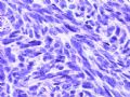 [已确诊]胸壁（乳腺）肿瘤- 纤维肉瘤型DFSP图12