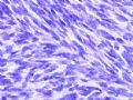 [已确诊]胸壁（乳腺）肿瘤- 纤维肉瘤型DFSP图13