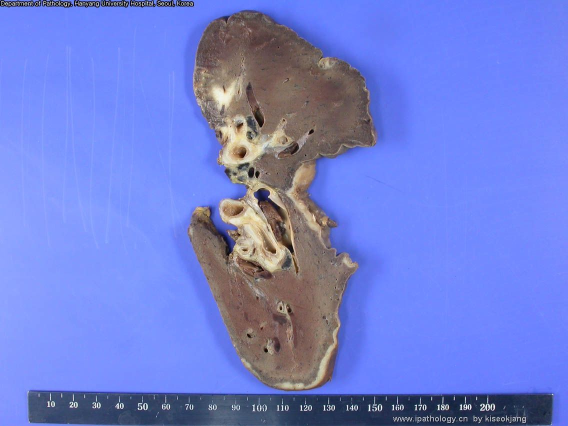 HYUH Case 1 What is your diagnosis? (pleural mass)图1