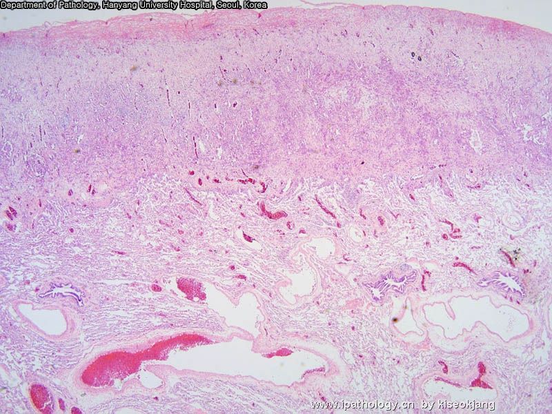 HYUH Case 1 What is your diagnosis? (pleural mass)图2