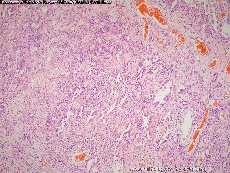 HYUH Case 1 What is your diagnosis? (pleural mass)图3